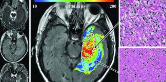glioma