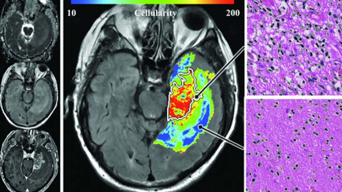 glioma