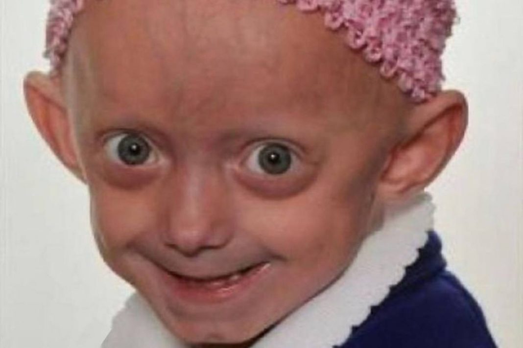 Sindrome Di Moschowitz Si Muore