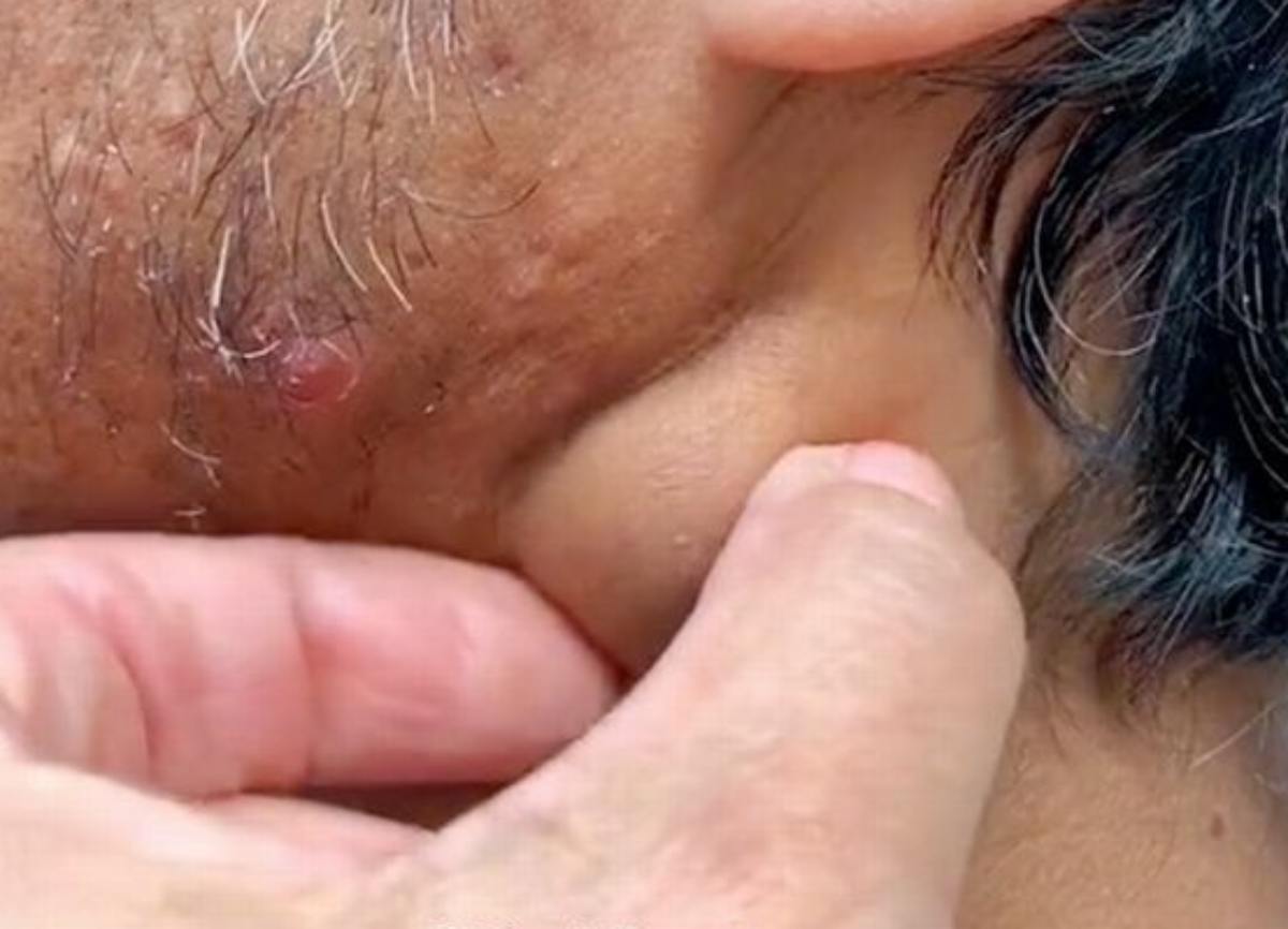 dottoressa pimple popper