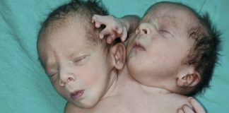parto neonato deforme