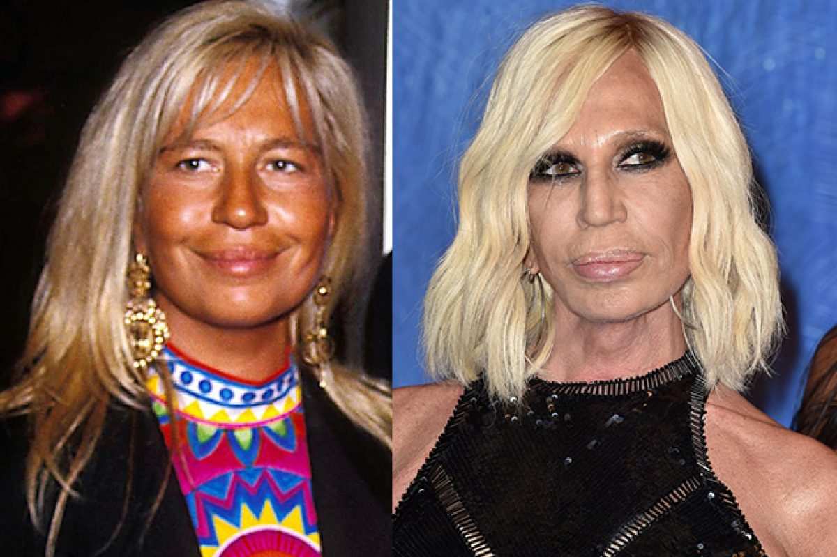 donatella-versace-prima-chirurgia