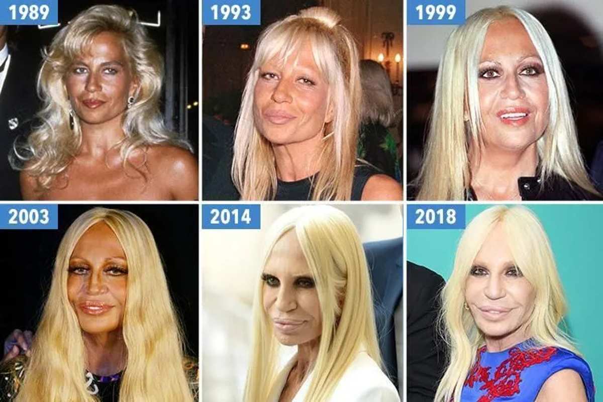 donatella-versace-chirurgia-estetica